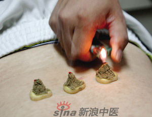 灸法的種類  你知道多少？